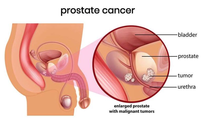 Prostate Cancer