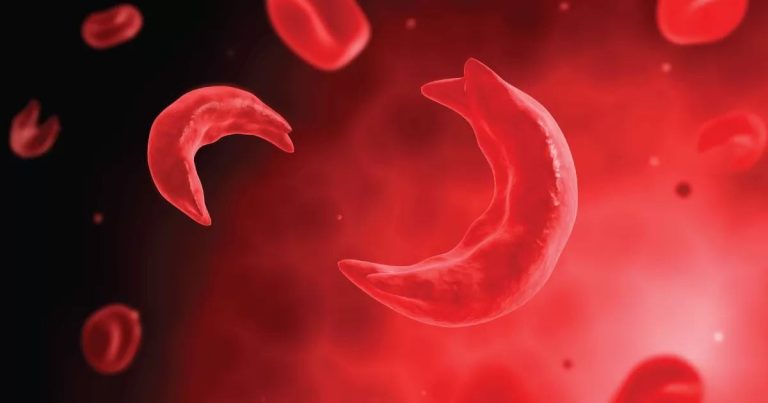Health Advocates Seek Mandatory Genotype Screening Before Marriage Sickle Cell